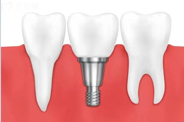 种牙后能立刻啃苹果吗?不能,分享关于种植牙承重能力的真相 种牙后能立刻啃苹果吗?不能,分享关于种植牙承重能力的真相