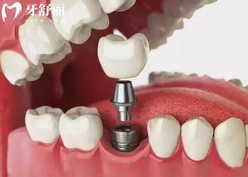 海宁牙博士口腔医院收费怎么样高吗?2026价格表:韩系种植牙2780+自锁8700+镶牙/拔牙也不贵 海宁牙博士口腔医院收费怎么样高吗?2026价格表:韩系种植牙2780+自锁8700+镶牙/拔牙也不贵