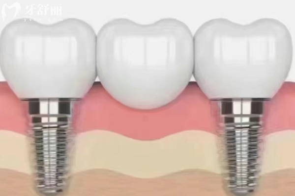 1761719467625767.png 种植牙搭桥.png