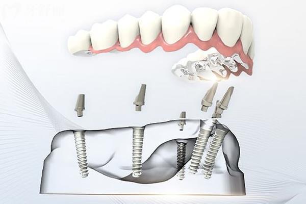 六安悦牙口腔种植牙价格 六安悦牙口腔种植牙价格