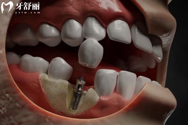 六安悦牙口腔种植牙价格 六安悦牙口腔种植牙价格