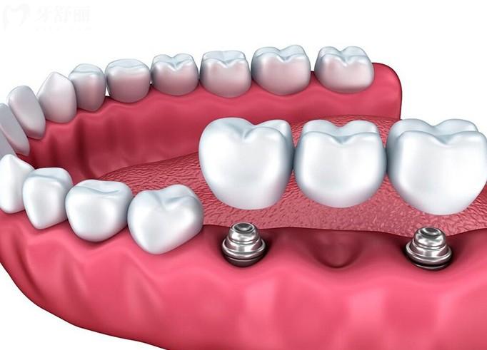 鄂尔多斯种植牙哪个医院好?2026口碑好的5家正规牙科单颗半口全口种牙很不错 鄂尔多斯种植牙哪个医院好?2026口碑好的5家正规牙科单颗半口全口种牙很不错