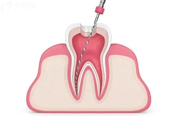 根管治疗后戴的牙套能用多久 根管治疗后戴的牙套能用多久
