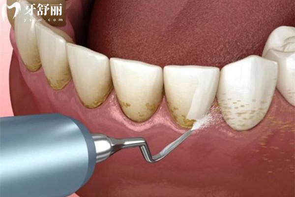 天牙口腔医院收费标准 天牙口腔医院收费标准