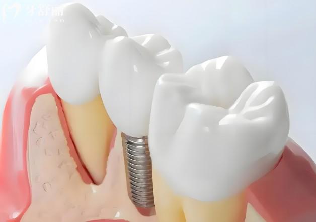 2026苏州种植牙价格新版出炉:多家正规口腔种植牙收费不贵 2026苏州种植牙价格新版出炉:多家正规口腔种植牙收费不贵