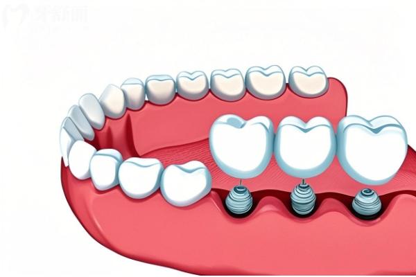 韩国科威尔种植牙怎么样 韩国科威尔种植牙怎么样