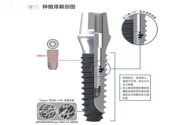 韩国种植体十大品牌排行榜!登腾/奥齿泰/八维/仕诺康等性价比高1500元起 韩国种植体十大品牌排行榜!登腾/奥齿泰/八维/仕诺康等性价比高1500元起