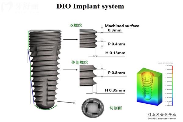 韩国种植体十大品牌排行榜!登腾/奥齿泰/八维/仕诺康等性价比高1500元起 韩国种植体十大品牌排行榜!登腾/奥齿泰/八维/仕诺康等性价比高1500元起