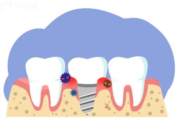 50-60种牙2026价格表一览:单颗/半口/全口种植牙收费新标准,种牙不迷路 50-60种牙2026价格表一览:单颗/半口/全口种植牙收费新标准,种牙不迷路