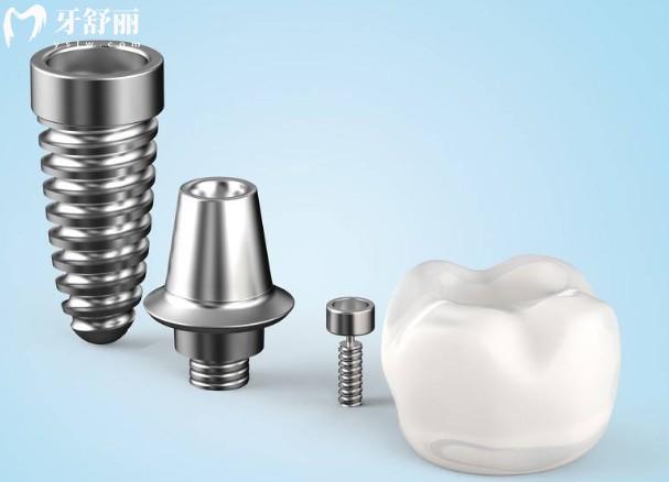 50-60种牙2026价格表一览:单颗/半口/全口种植牙收费新标准,种牙不迷路 50-60种牙2026价格表一览:单颗/半口/全口种植牙收费新标准,种牙不迷路