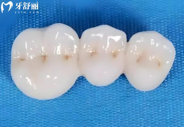 威兰德牙冠有几个档次?6个档次,解析六个档次材质/使用寿命/价格 威兰德牙冠有几个档次?6个档次,解析六个档次材质/使用寿命/价格