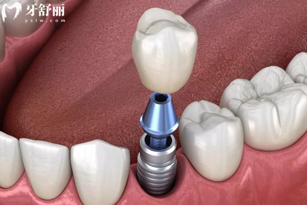 韩国柯威尔亲水种植体价格不贵 韩国柯威尔亲水种植体价格不贵
