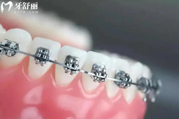 正畸2x4技术是什么？