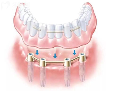 2026拜博口腔收费高不高?价格表明细一览:韩系种植牙2080元起、自锁矫正8800元起、松动牙19.9元起超亲民