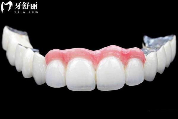 吸附性义齿有几个品牌，几个档次，多少钱？