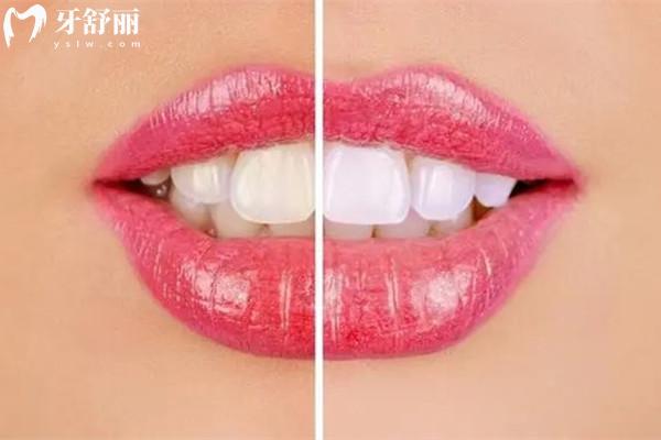 牙齿贴面材料有哪几种类型，区别是什么？