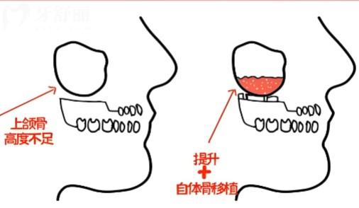 种植牙外提和内提是什么意思?揭秘这两者的区别/手术难度/价格