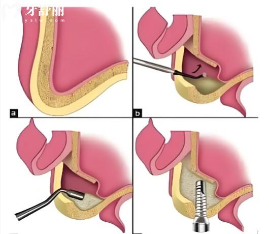 种植牙外提和内提是什么意思?揭秘这两者的区别/手术难度/价格
