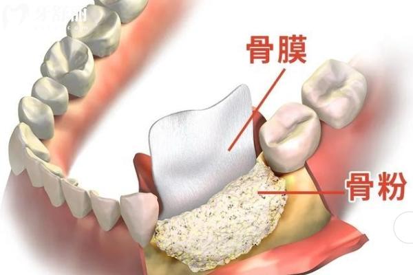 Biooss骨粉是哪的