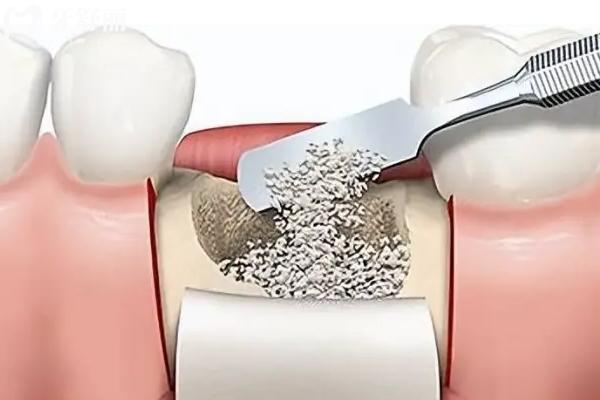 Biooss骨粉是哪的