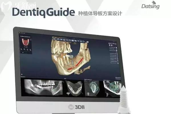 大清西格和奥齿泰种植体怎么选