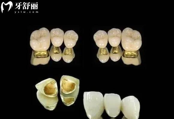 团圆口腔收费贵吗2026价目表:种植牙1980-8000元起(含韩系/瑞典等)矫正