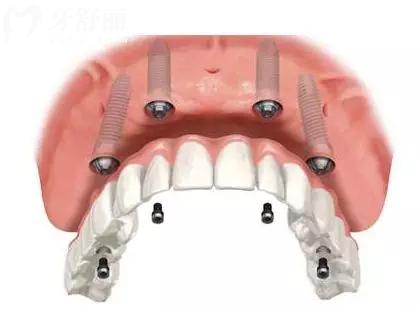 西安弗莱堡口腔地址(3家分院)+收费标准:2026种植牙