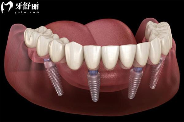 60-70岁老年人种植牙多少钱?单颗2000起/半口2万起/全口4万起选好医院种牙省钱又安心