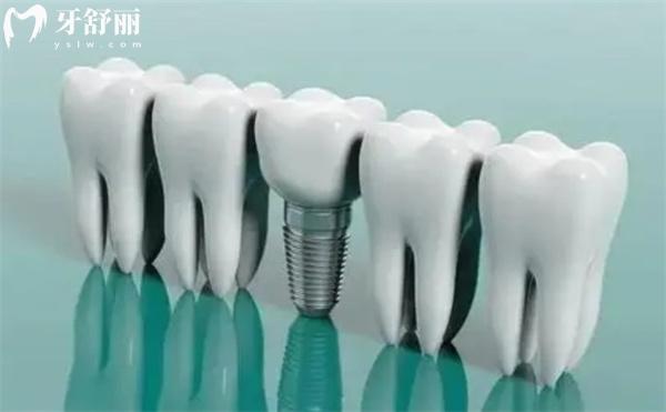 沈阳镶牙哪家好还便宜?手把手教你选沈阳镶假牙性价高的牙科医院 沈阳镶牙哪家好还便宜?手把手教你选沈阳镶假牙性价高的牙科医院