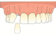 哪5种人不宜种植牙