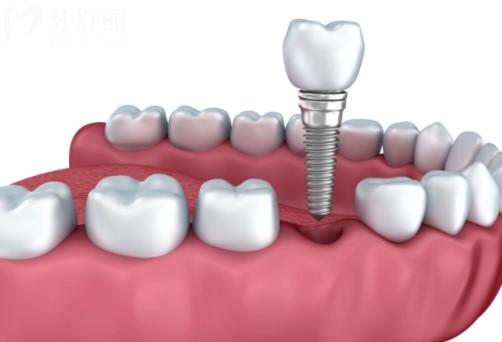 哪5种人不宜种植牙