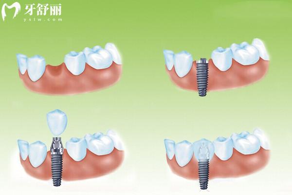 种植牙当天种植当天用是真的吗？