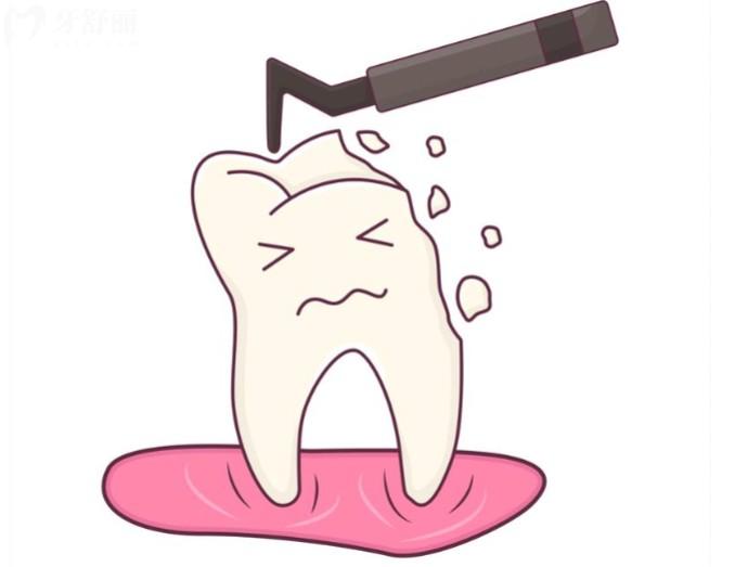 补牙一般用什么材料好?树脂/嵌体常用,收费价格/适应部位/使用寿命分享