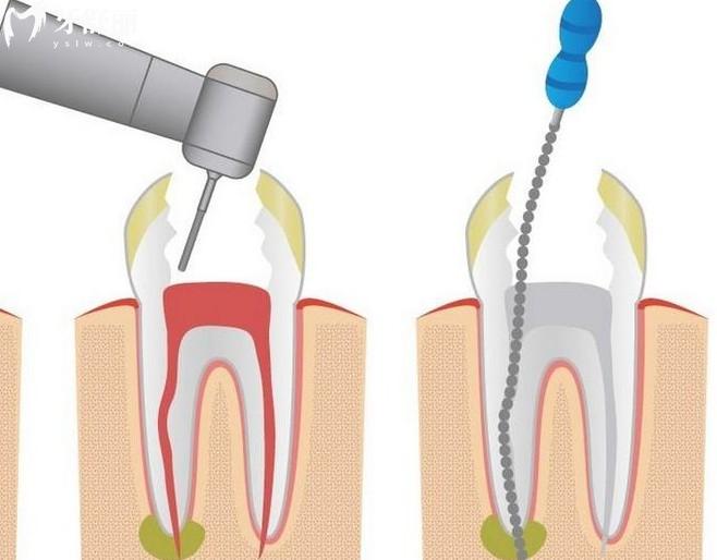 深圳根管治疗价格表 深圳根管治疗价格表