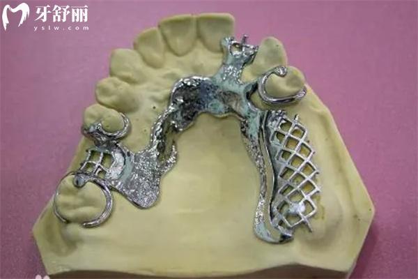 假牙钢托.jpg