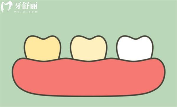 做牙齿美白可以提升几个色阶?2-5个,冷光美白与瓷贴面技术深度解析