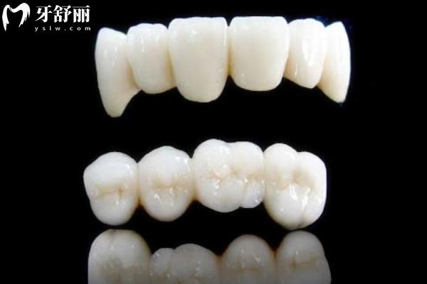 威兰德臻瓷VS全瓷