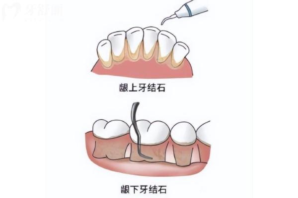 牙结石能自己抠掉吗