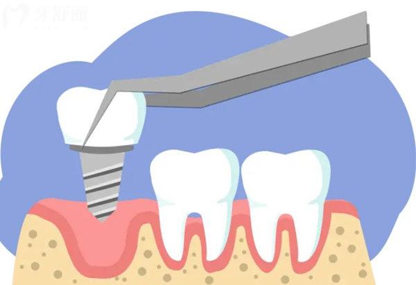 潍坊种植牙价格表