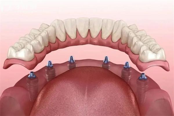 all-on-6种植牙 (2).jpg