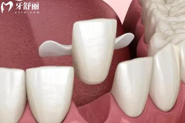 粘结桥修复贵吗？耐用吗