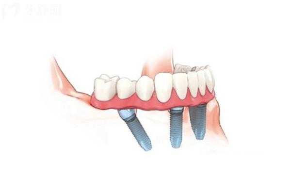 半口6颗种植牙和单独6颗的区别在哪？