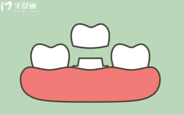 拉瓦全瓷牙怎么辨别真假?看质量如何价格5000起一颗
