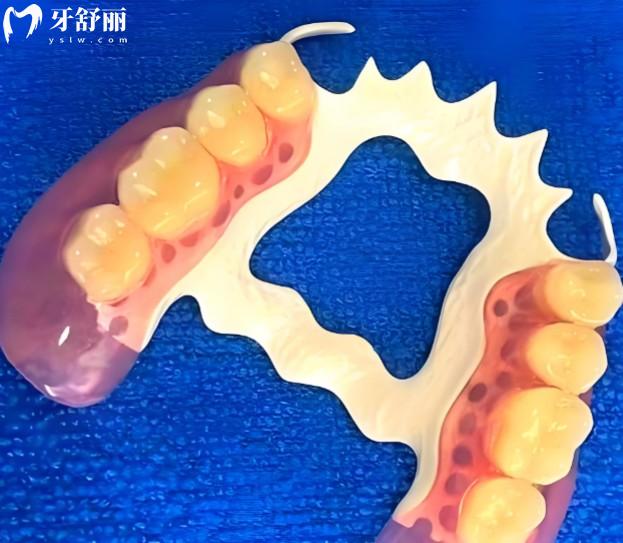 pK支架义齿和Hpp支架哪个好?对比:从材料到舒适度全解析,助您选择合适的义齿