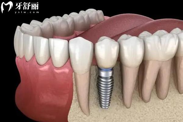 海口诺贝尔口腔看牙贵吗多少钱2026收费标准:镶牙680元起、金属矫正5800元起、种植牙1580元起