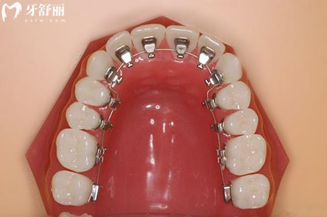 海口诺贝尔口腔看牙贵吗多少钱2026收费标准:镶牙680元起、金属矫正5800元起、种植牙1580元起