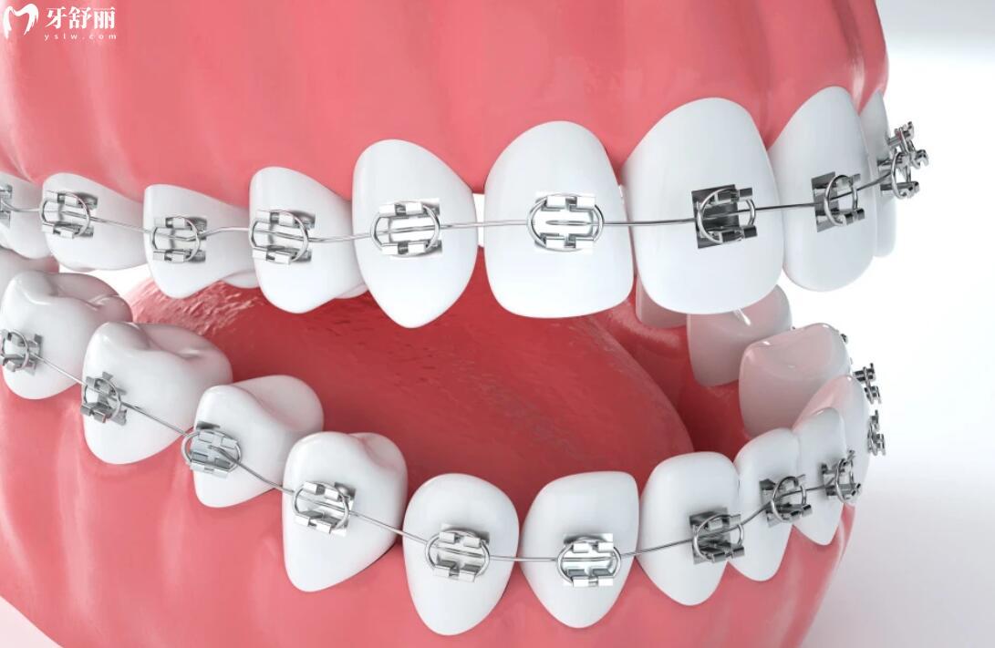 上海瑞伢美口腔地址(有9家)+收费标准全公开:26年种植牙/正畸/镶牙/拔牙费用同步更新