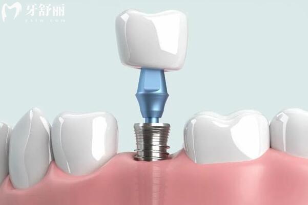 南昌博 德口腔怎么样?正规靠谱!26年收费标准显示(进口种植牙1680+金属矫正6000+)