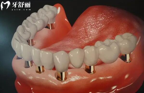 【点击领取】南昌摩尔口腔医院价格表更新至2026,种植牙