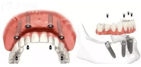 纠结半口种植牙选4颗还是6颗？除了价格和数量不同外，稳定性与耐用性也不同